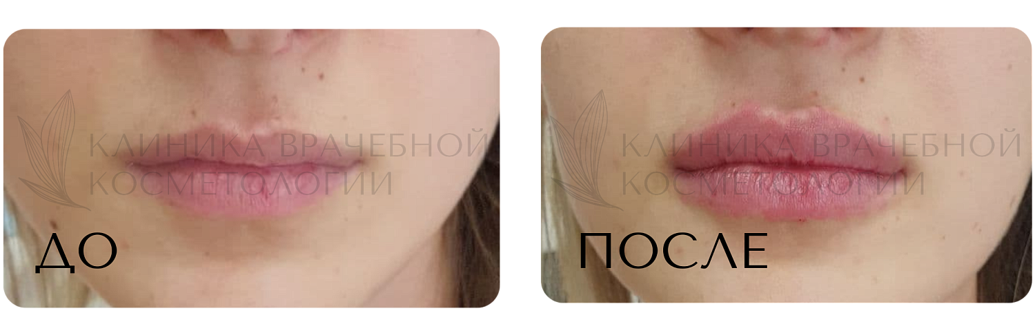 Процедуры для губ
