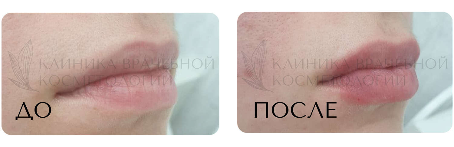 Процедуры для губ